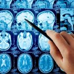 COVID Vaccines and Brain Hemorrhages: The Unseen Link? Hand pointing at brain scan images on screen.